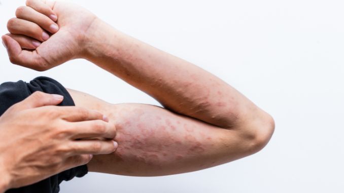 Allergic Dermatitis - Hives Vs Rash