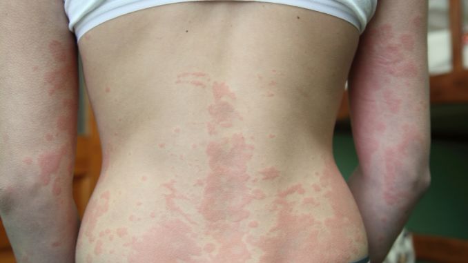 Allergic Dermatitis - Hives Vs Rash