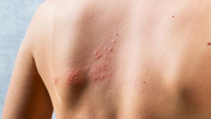 chicken pox rash - Hives Vs Rash