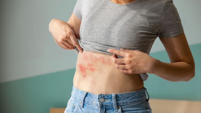painful shingles in woman - Hives Vs Rash