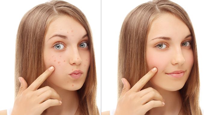 Acne Facial Elegance: Mastering the Art of Clear Skin