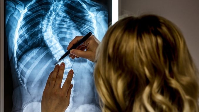 Understanding Scoliosis Causes, Symptoms, and Diagnosis