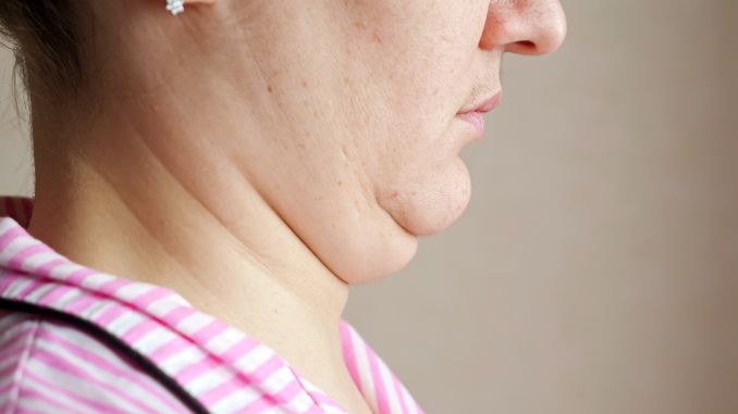 The Role of Exercise in Double Chin Reduction