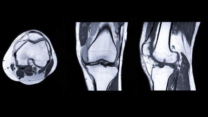 What is a meniscus tear?