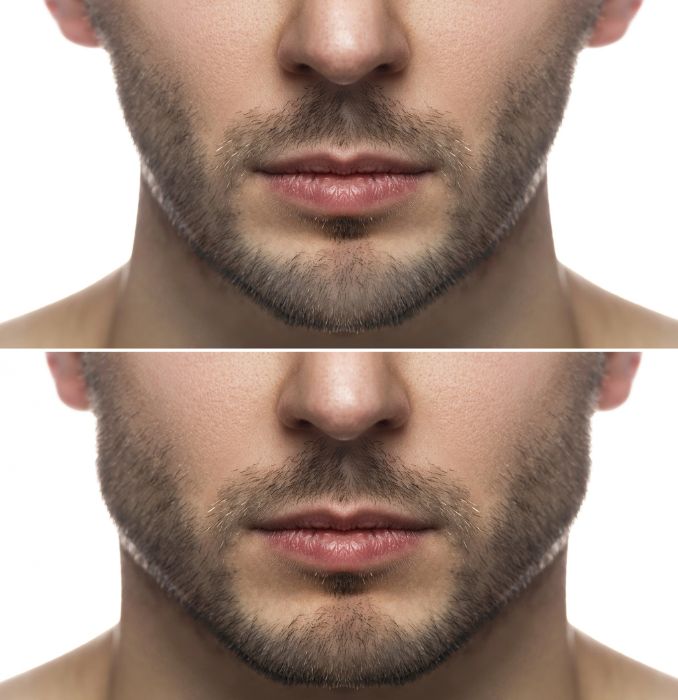 jawline-reshape-surgery