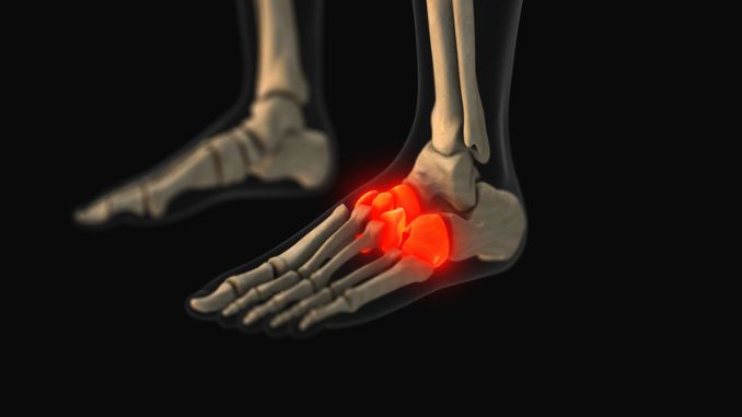 What is a Midfoot Sprain?