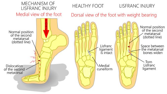 Understanding Midfoot Sprains: Prevention, Treatment, and Recovery