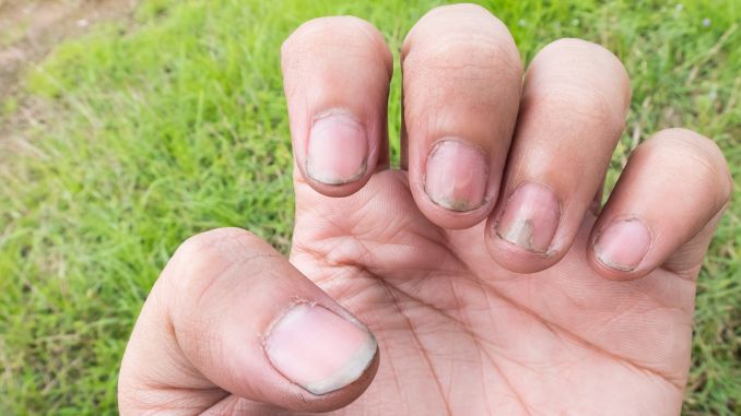 dirty-fungus-nail - collagen benefits for men