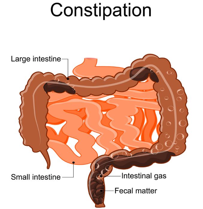 Constipation. Vector illustration