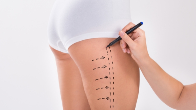 Liposuction