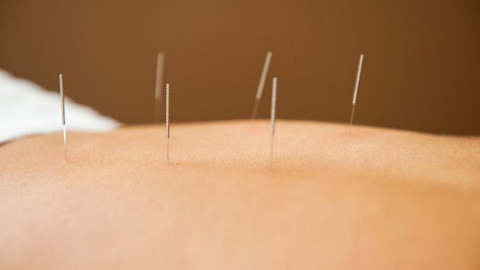 acupuncture-treatment - acupuncture for scar tissue