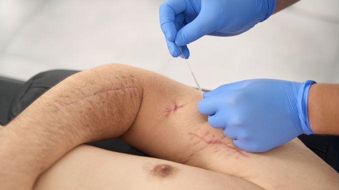 doctor-conducts-acupuncture-session - acupuncture for scar tissue