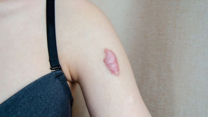 keloid-scar-on-shoulder