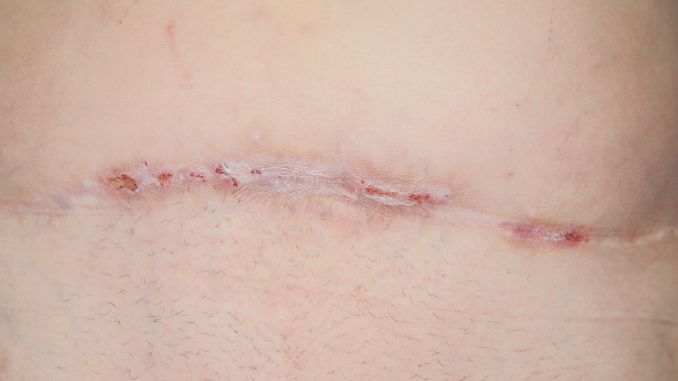 scar-from-a-hysterectomy - acupuncture for scar tissue