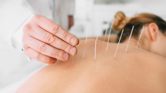 woman-having-acupuncture-treatment-on-her-back